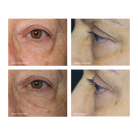 dermalogica awaken peptide eye gel før og etter