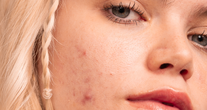 5 vanlige hudpleiefeil ved kviser