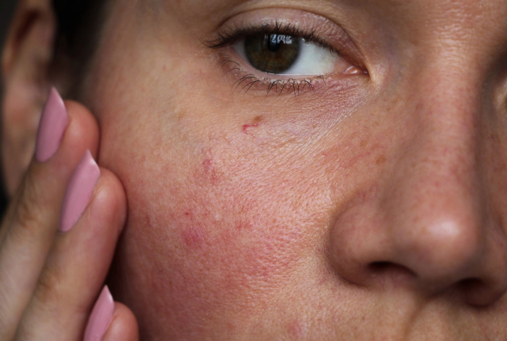 hvordan behandle en sensitiv hud